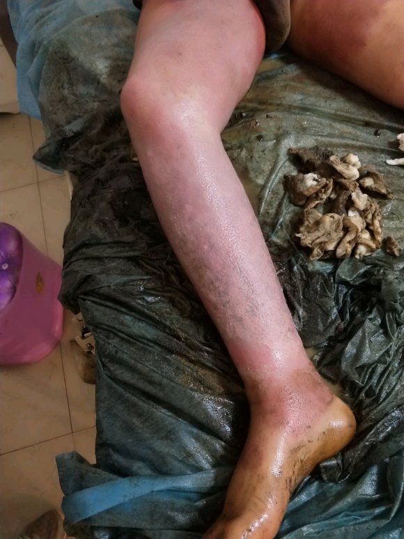 烧烫伤疤痕治疗 烧烫伤疤痕去哪里治疗