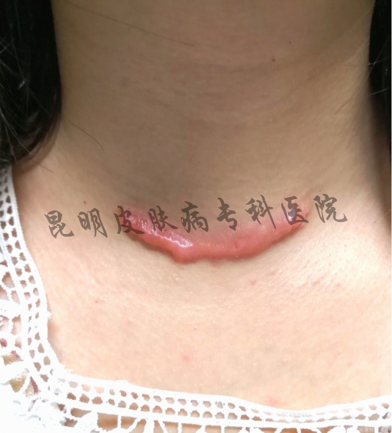 增生疤痕怎么治疗 增生疤痕去哪里治疗